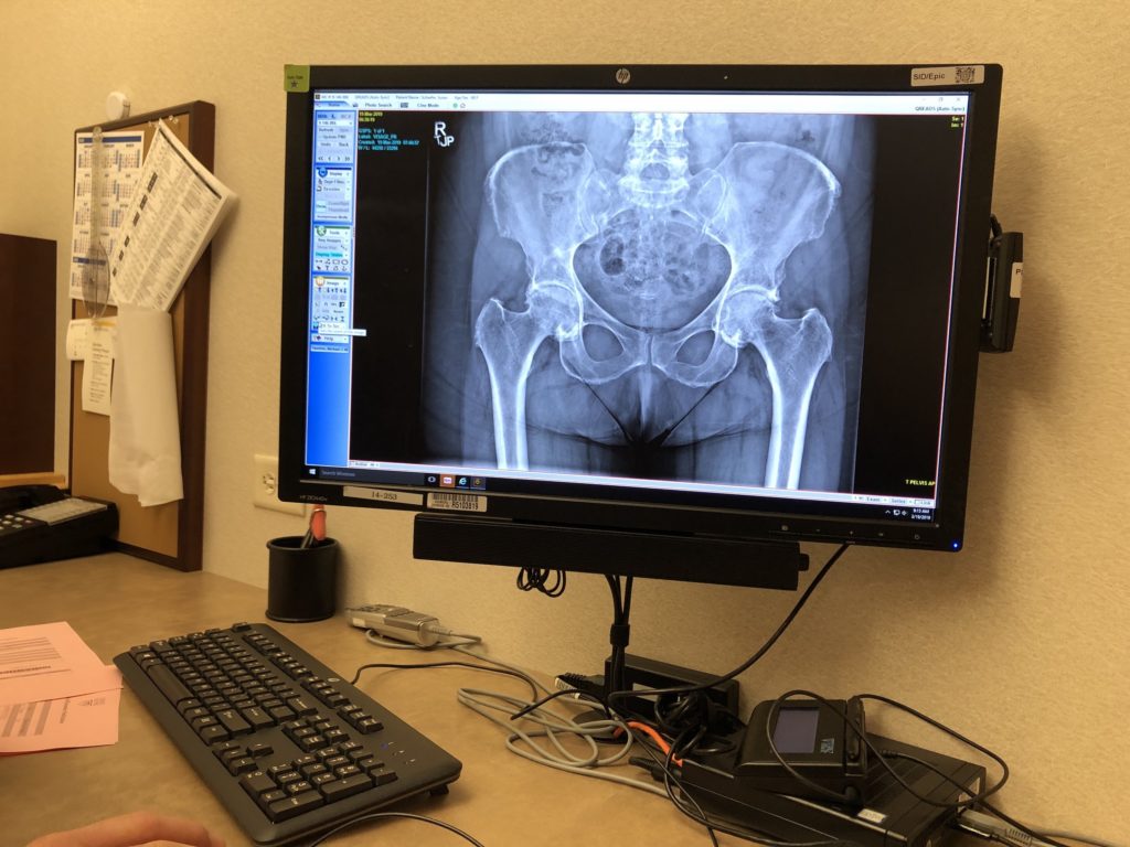 X-ray showing massive arthritic deterioration