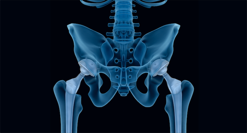 hip replacement